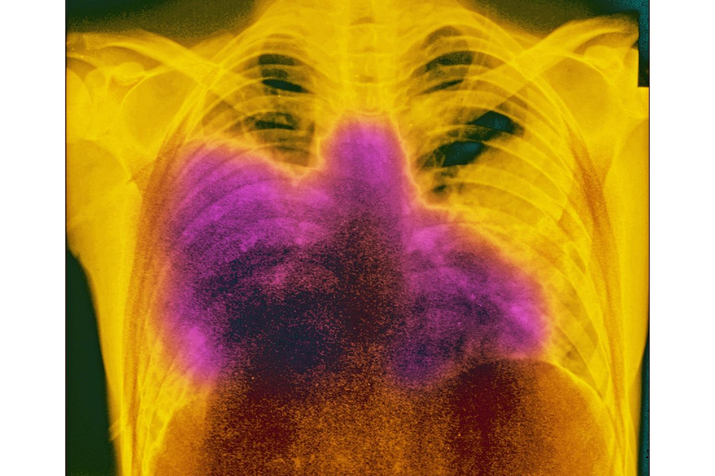 A frontal chest x-ray showing the effects of pneumonia from Legionnaires'